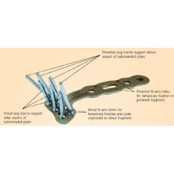 Distal Volar Radius-Anatomic Plate